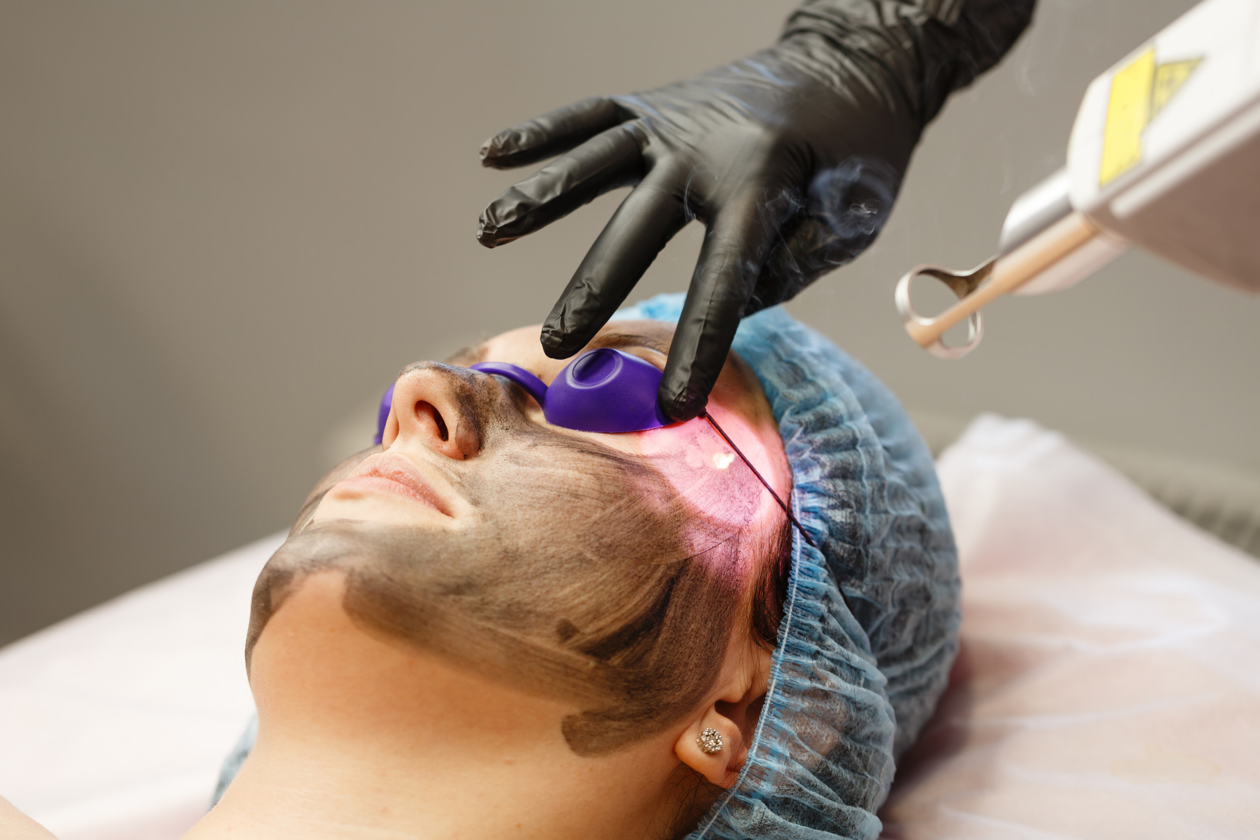 Carbon Glass Facial